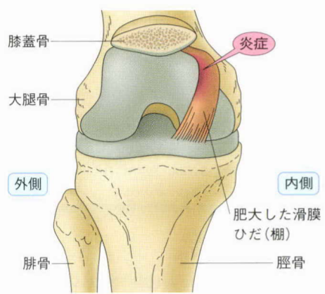 膝の痛み タナ障害 について はロックされています 膝の痛み タナ障害 について トリガーポイント療法専門 もりかわ鍼灸治療院